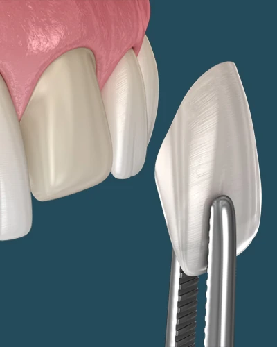 diagram showing how a dental veneer is placed