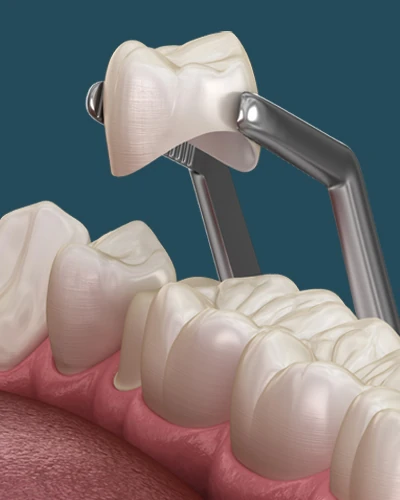 diagram showing how a dental crown is placed