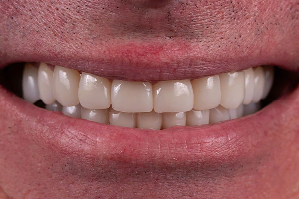 After image